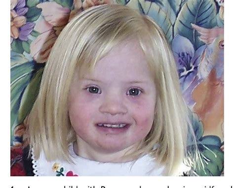 Medical conditions that cause the nasal bridge to not mature and project are associated with epicanthic folds. Flat Nasal Bridge And Epicanthal Folds / Flat Nasal Bridge ...