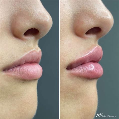 Lip Fillers Starting From 299 M1 Med Beauty Australia