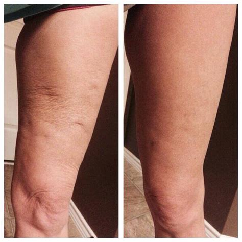70 To Remove Cellulite And Stretch Marks In Days Musely