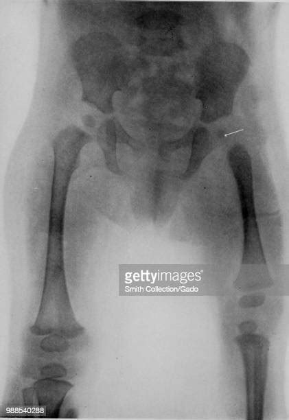 Baby Xray Photos And Premium High Res Pictures Getty Images