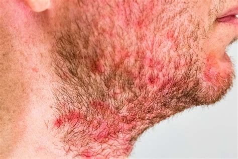 Seborrheic Dermatitis Symptoms Causes Risk Factors And More Pure
