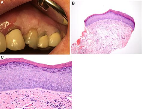 Hyperkeratosis And Epithelial Atrophy Not Reactive A Demarcated