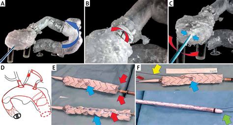 Externalized Transapical Guidewire Technique After Artificial Aortic