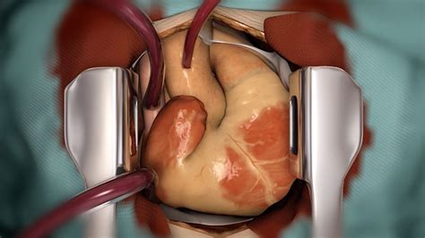 Heart Transplantation A Treatment For Heart Failure YouTube
