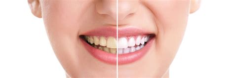 Causes Treatments And Prevention Of Tooth Discoloration Biscayne