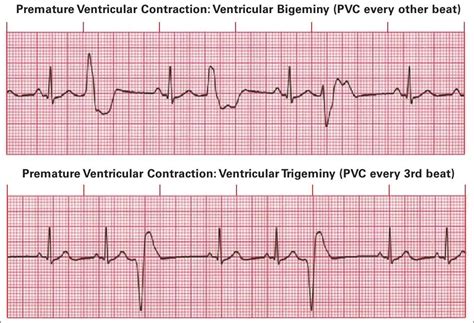 Premature Ventricular Contractions Treatment Cape Town