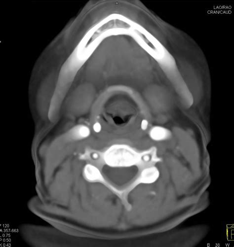 Normal Cta Of The Head And Neck Neuro Case Studies Ctisus Ct Scanning
