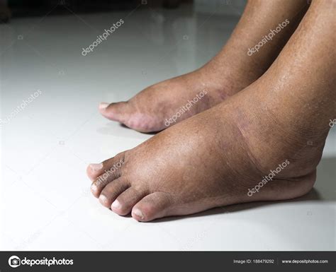 Feet People Diabetes Dull Swollen Due Toxicity Diabetes Placed White
