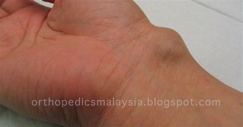 Ganglion Cyst Swelling In The Wrist The Orthopedics Malaysia Blog