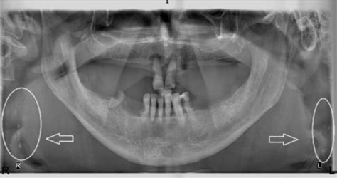 A Panoramic Radiograph Of A 76 Year Old Female There W Open I
