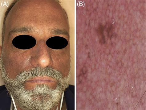 A Progressive Acquired Hyperpigmentation On The Face And Neck B