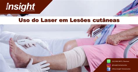 CURSO Uso de Laser no Tratamento de Lesões Cutâneas em Lorena 2023