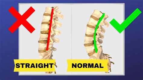 How To Correct Straightening Of Lumbar Spine Fix Loss Of Lumbar