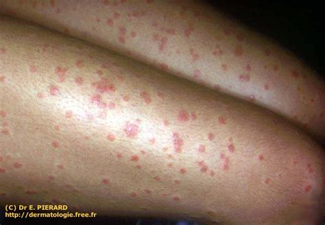 Dermatologie Psoriasis Aigu En Gouttes Streptocoque Acute Guttate
