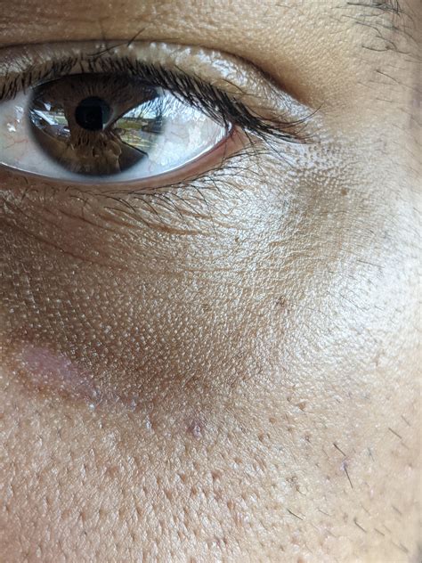 Skin Concerns Developed These Small Bumps Under Both Of My Eyes The