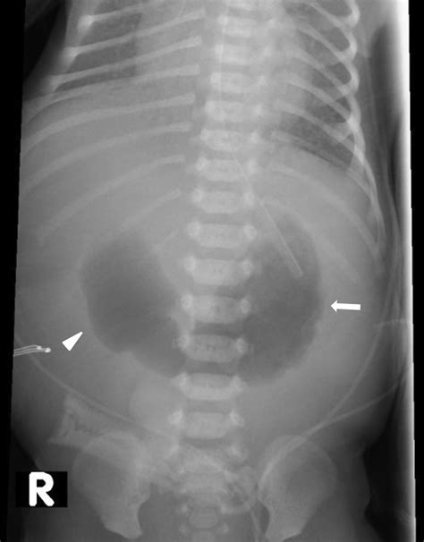 Neonatal And Pediatric Bowel Obstruction Radiology Key