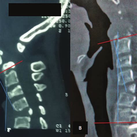 Review Of All Cases Of Surgically Corrected Cervical Kyphosis In