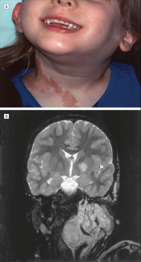 Management Of Head And Neck Plexiform Neurofibromas In Pediatric