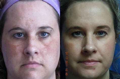 Laser Skin Rejuvenation Before And After Pictures Case 12 Coeur D
