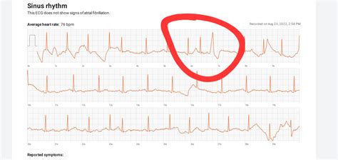 Is It Possible For A Pvc To Immediately Follow A Pac Recg