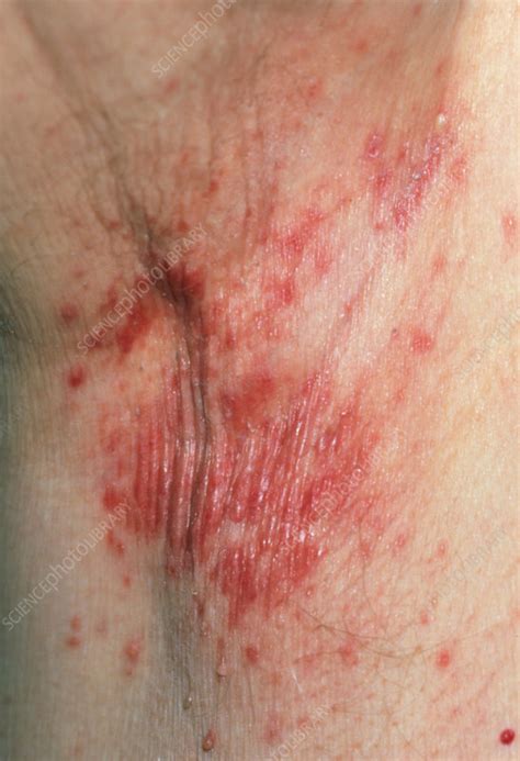 MRSA Bacterial Infection In Skin In Man S Armpit Stock Image M180