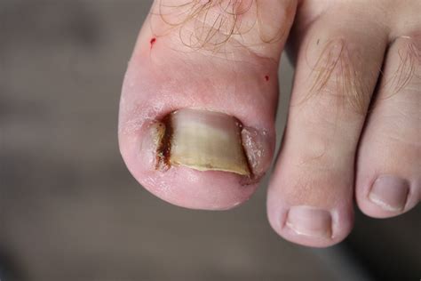 A Simple Guide On How To Prevent Ingrown Toenails