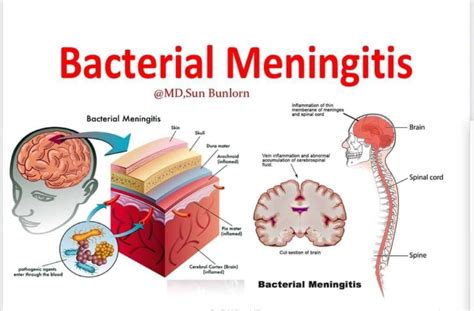 Bacterial Meningitis Nurseinfo