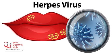 Herpes Zoster Lips Causes