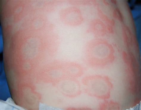 This is called an allergic reaction. Low Histamine Diet may Help Get rid of Chronic Urticaria ...