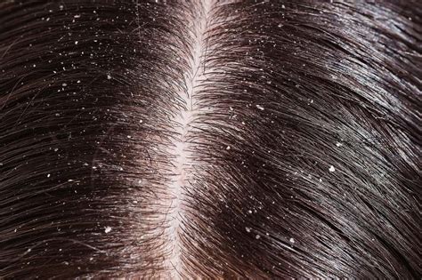 A Brief Overview Of Dandruff Vs Dry Scalp Comparison