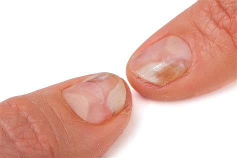 Fungus thrives and grows in hot, humid environments. Nail Fungus from Acrylic Nails | Cause, Treatment & Prevention