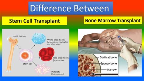 Difference Between Stem Cell Transplant And Bone Marrow Transplant