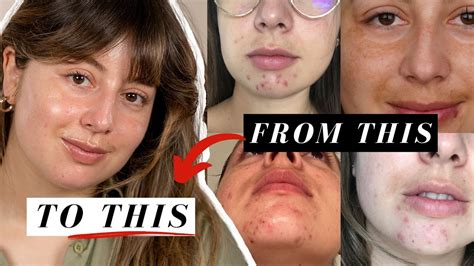 How I Got Rid Of My Breakouts And Cleared My Acne In Just 4 Months