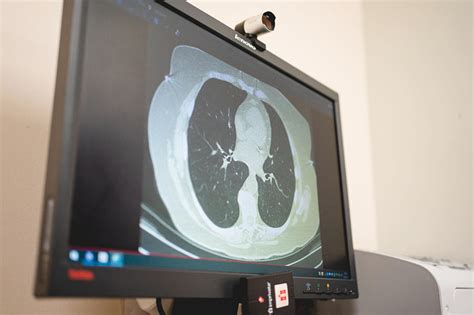 Largest Ever Lung Cancer Screening Study Reveals Ways To Increase