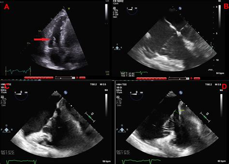Tricuspid Valve Prolapse An Uncommon Pathology Revealed By Tee