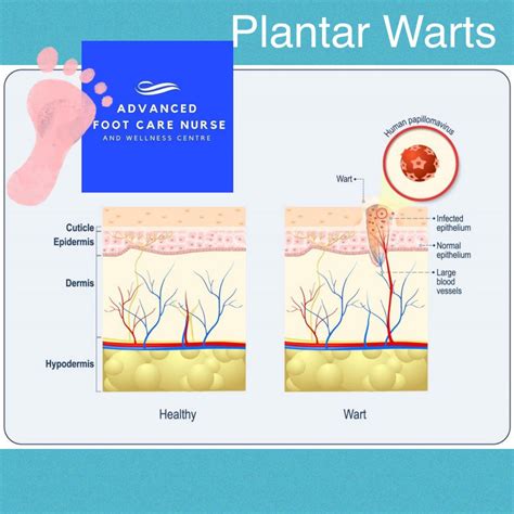 Anatomy Of A Plantar Wart