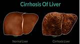 Images of Poor Liver Health Symptoms