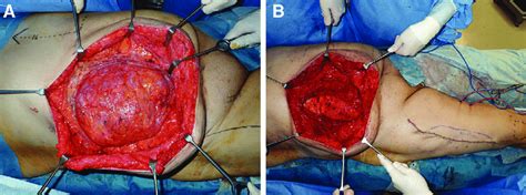 Intraoperative Findings During The Incisional Hernia Reconstruction A