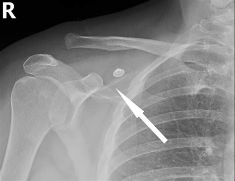Cureus Failure Of Acromioclavicular Joint Reconstruction Eight Weeks