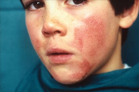 Facial Erythema And Onychoschizia—quiz Case Dermatology Jama