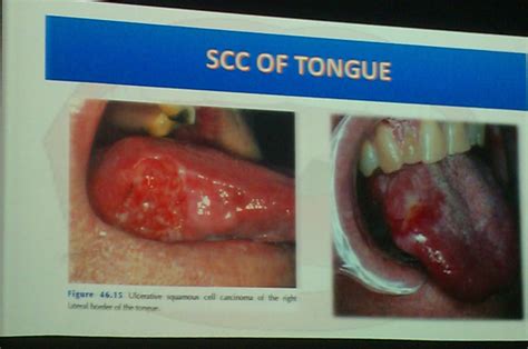 Lecture Slides Surgery Oral Cancers Tongue