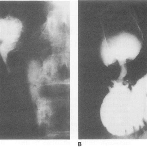 Pdf Endoscopic Balloon Dilatation Of Duodenal Strictures In Crohns