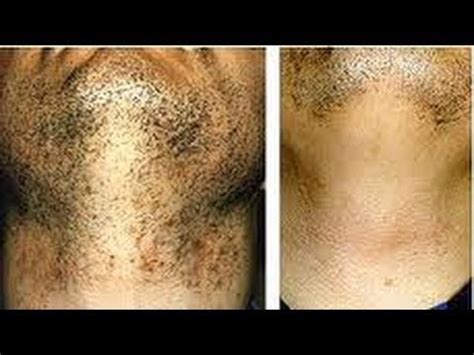 Ipl and laser hair removers arent just for women. Laser Hair Removal Miami & Help w/ Black Men's Beards ...