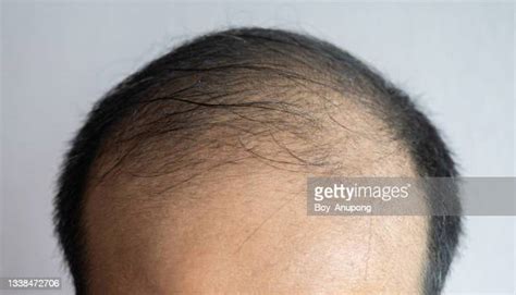 Bald White Thin Man Photos And Premium High Res Pictures Getty Images