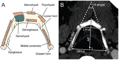 Anatomy Of Hyoid Bone And New Parameters A Schematic Of The Hyoid
