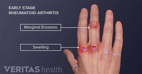 Hand Rheumatoid Arthritis Signs And Symptoms