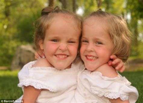 Conjoined Twins Became Famous In 2002 And 11 Years Later They Are Back