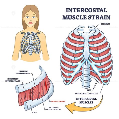 Intercostal Muscle Strain As Muscular Group In Chest Cavity Outline