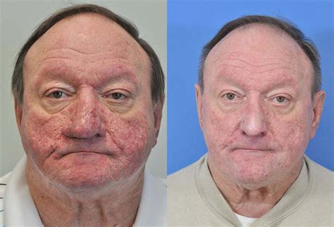 Rosecea And Rhinophyma Before And After Savannah Facial Plastic Surgery