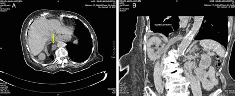 Right Sided Bochdalek Hernia Causing Septic Ureteric Obstruction